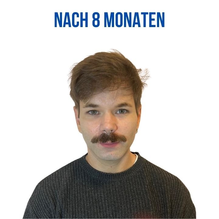 NacherHaartransplantation berlin NacherHaartransplantation