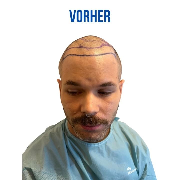Vorher Haartransplantation berlin Vorher Haartransplantation berlin