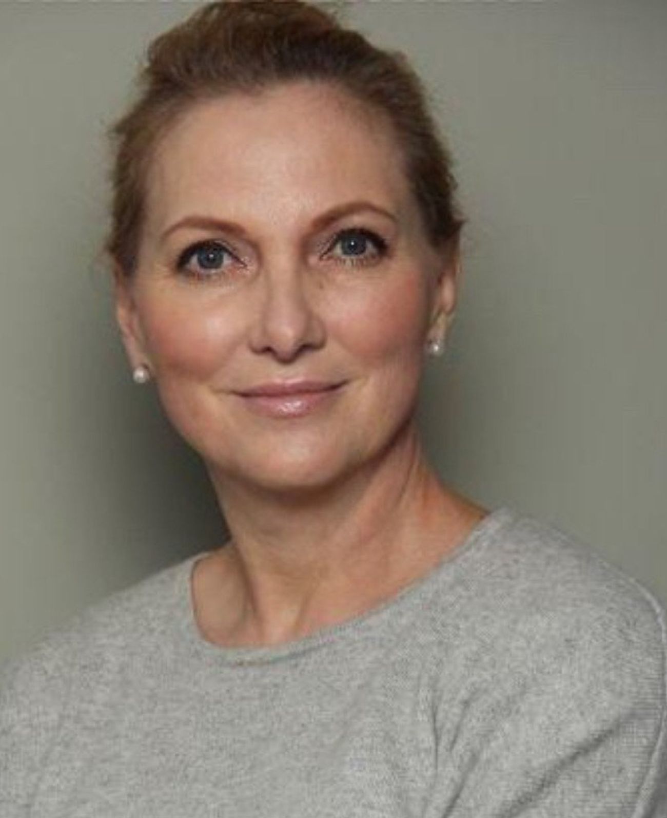 Haartransplantation Berlin Jungk 23213